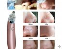Aparat Vacuum Presure Cleaner - pentru curatarea tenului